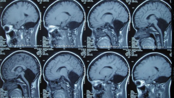 Revelaron más detalles asombrosos de la vida de la mujer que creció sin cerebelo