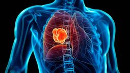 Cáncer de pulmón: alertan sobre el aumento de casos de la enfermedad en Argentina.