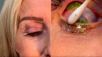 Una mujer tenía 23 lentes de contacto en los ojos