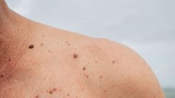 Qué significa tener lunares en el cuerpo Qué significa tener lunares en el cuerpo