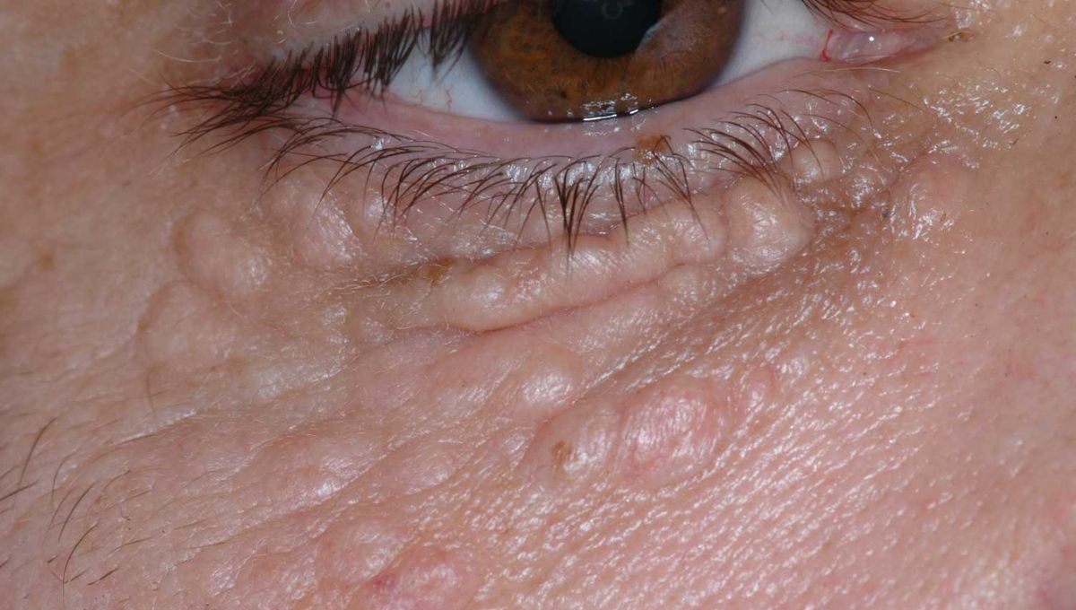 Quistes de milium: por qué aparecen y cómo sacarlos