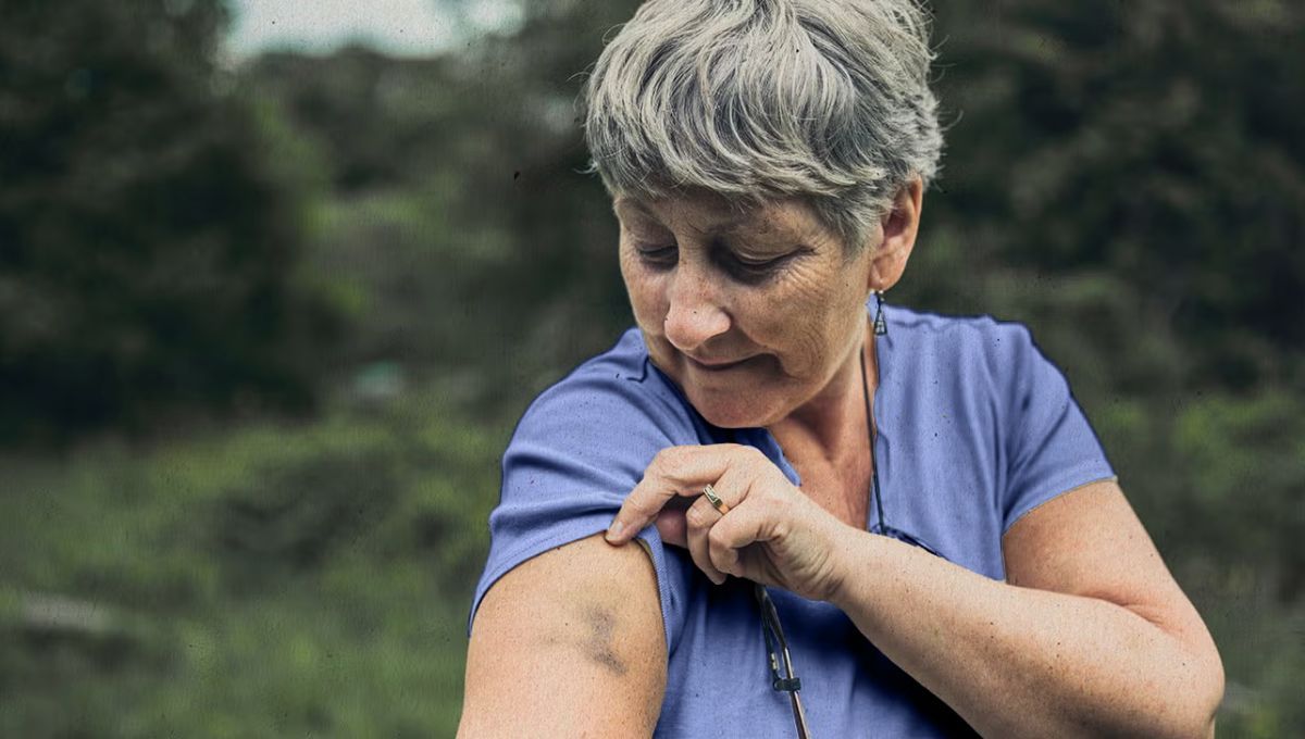 Los moretones sin causa son frecuentes en los adultos mayores