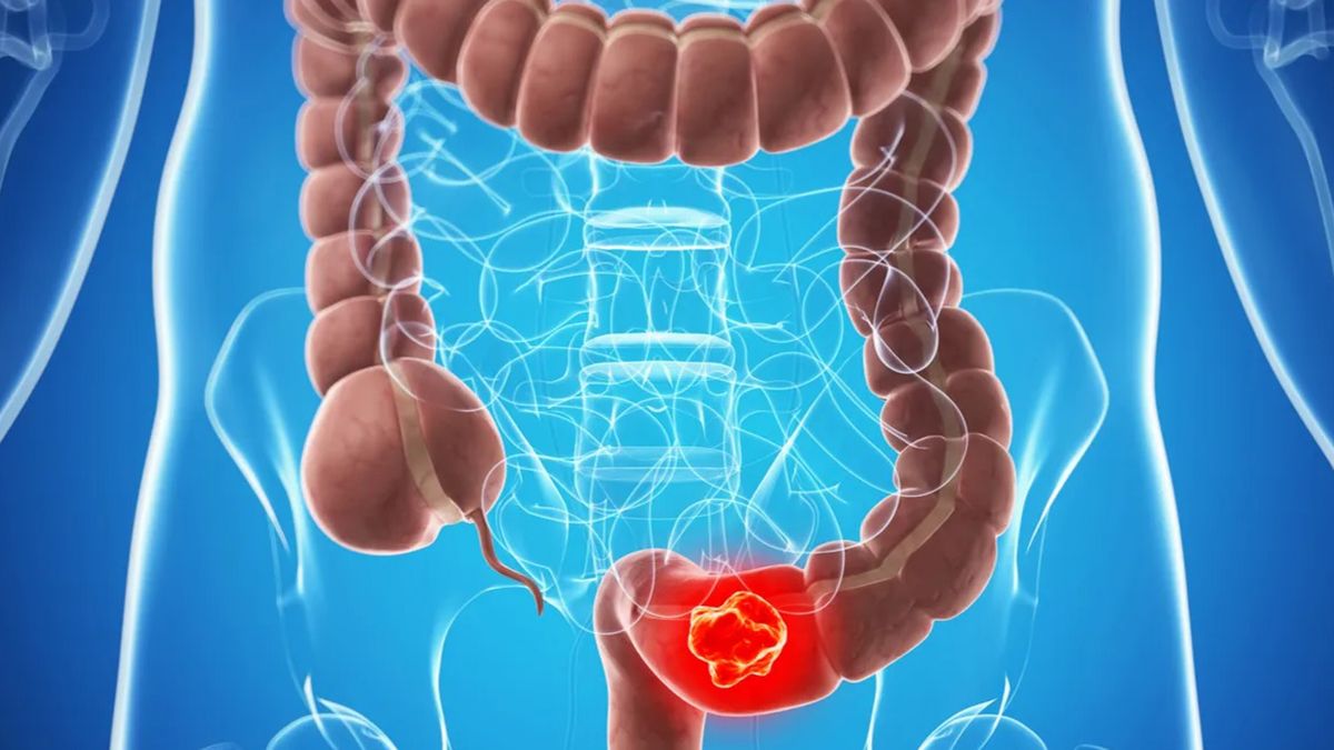 Cáncer de colon: cuál es el síntoma que es clave para detectarlo a tiempo