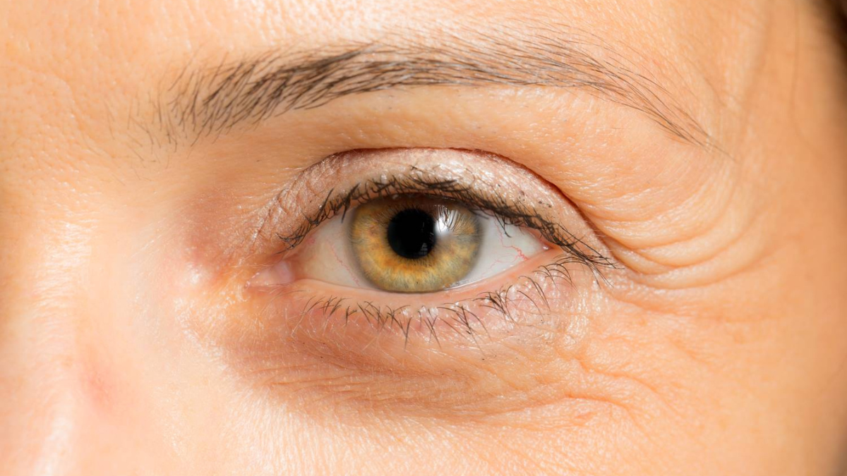 En el contorno de nuestros ojos por diversos factores pueden aparecer arrugas, estas son conocidas como patas de gallo. En el contorno de nuestros ojos por diversos factores pueden aparecer arrugas, estas son conocidas como patas de gallo.