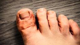 Los hongos de los pies pueden ser transmitidos fácilmente
