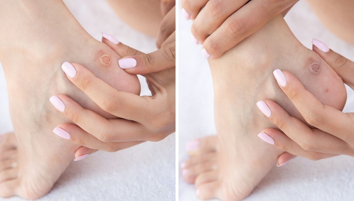 Cómo curar los callos de los pies con un remedio casero