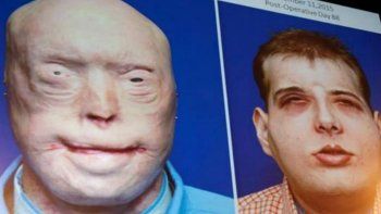 Realizan el más complejo y completo trasplante de cara