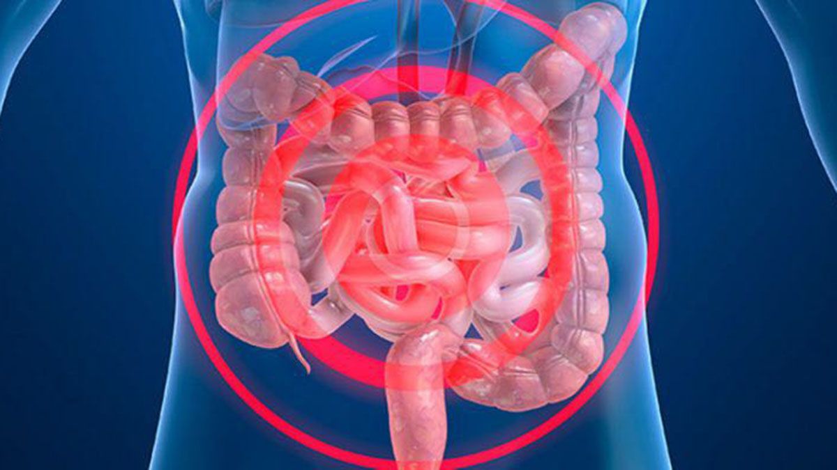 Difundieron recomendaciones que ayuden a reducir la inflamación intestinal para una buena cicatrización de la mucosa Difundieron recomendaciones que ayuden a reducir la inflamación intestinal para una buena cicatrización de la mucosa