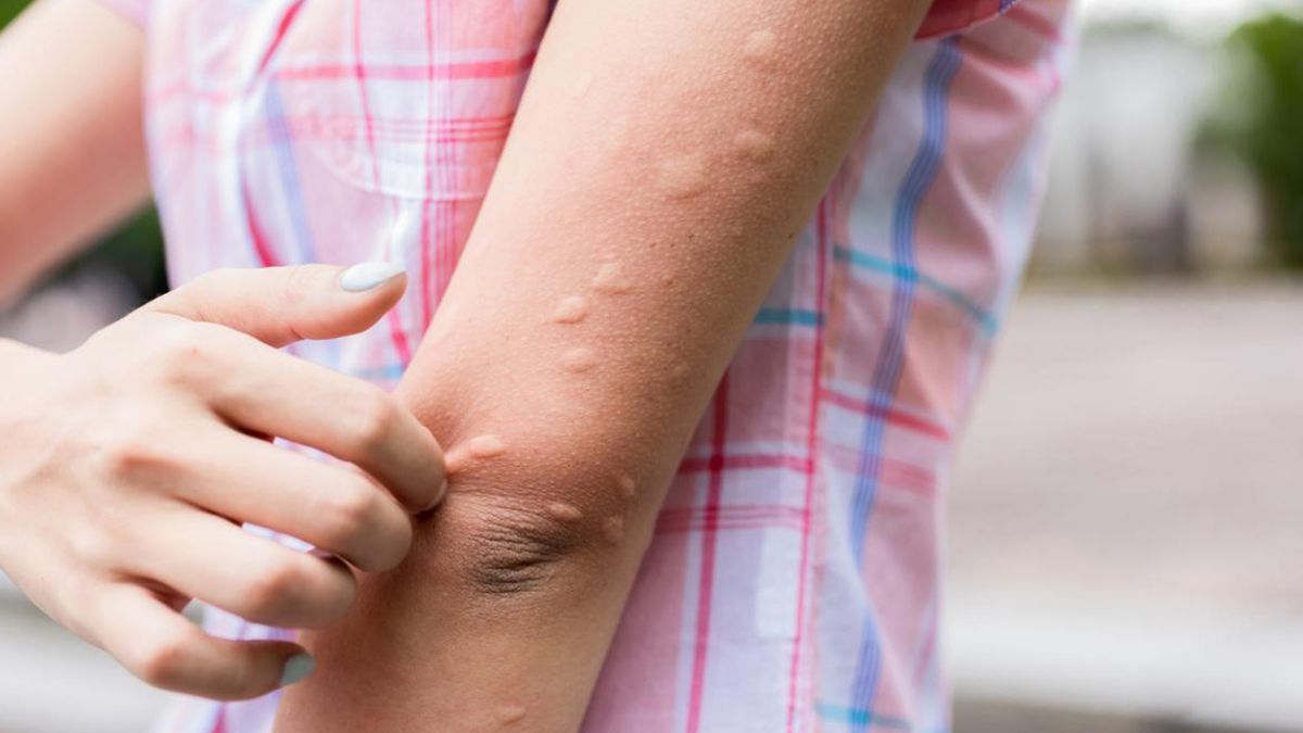 How to relieve mosquito bites with simple home tips