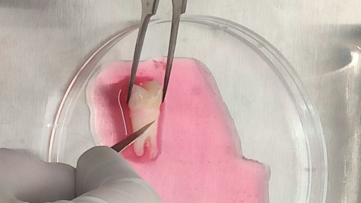El tejido periodontal se busca en piezas sanas, y luego se extraen las células madres.