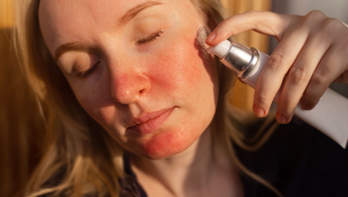 La rosácea no es solamente el enrojecimiento de la piel