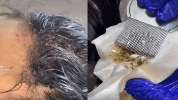 Una nena tenía más de 15 mil piojos en su cabeza