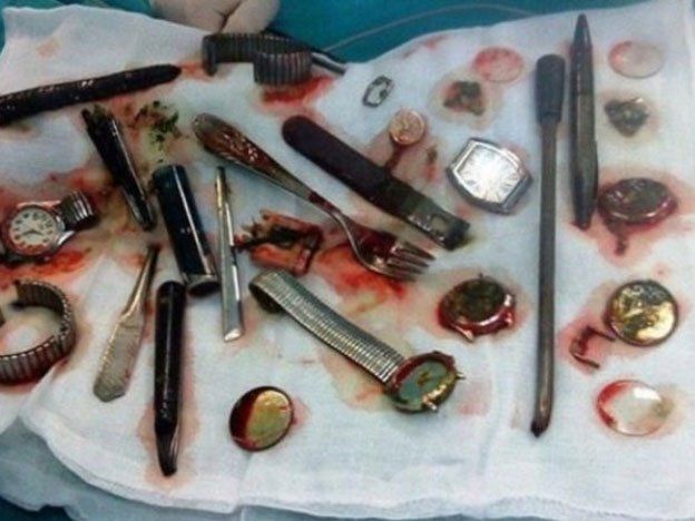 Un ladrón se tragó su botín para zafar de la policía
