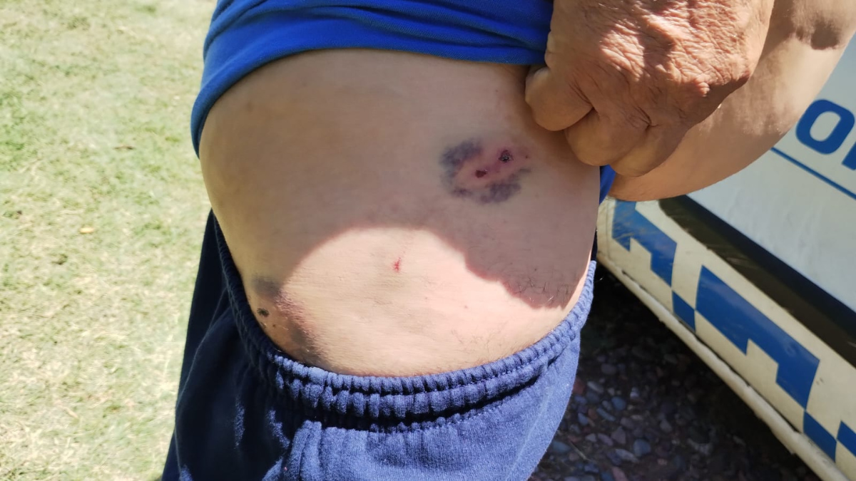 El hombre atacado muestra la herida que le causó una mordida. El hombre atacado muestra la herida que le causó una mordida.