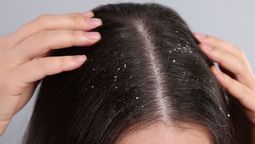 4 mezclas caseras para eliminar la caspa del cabello