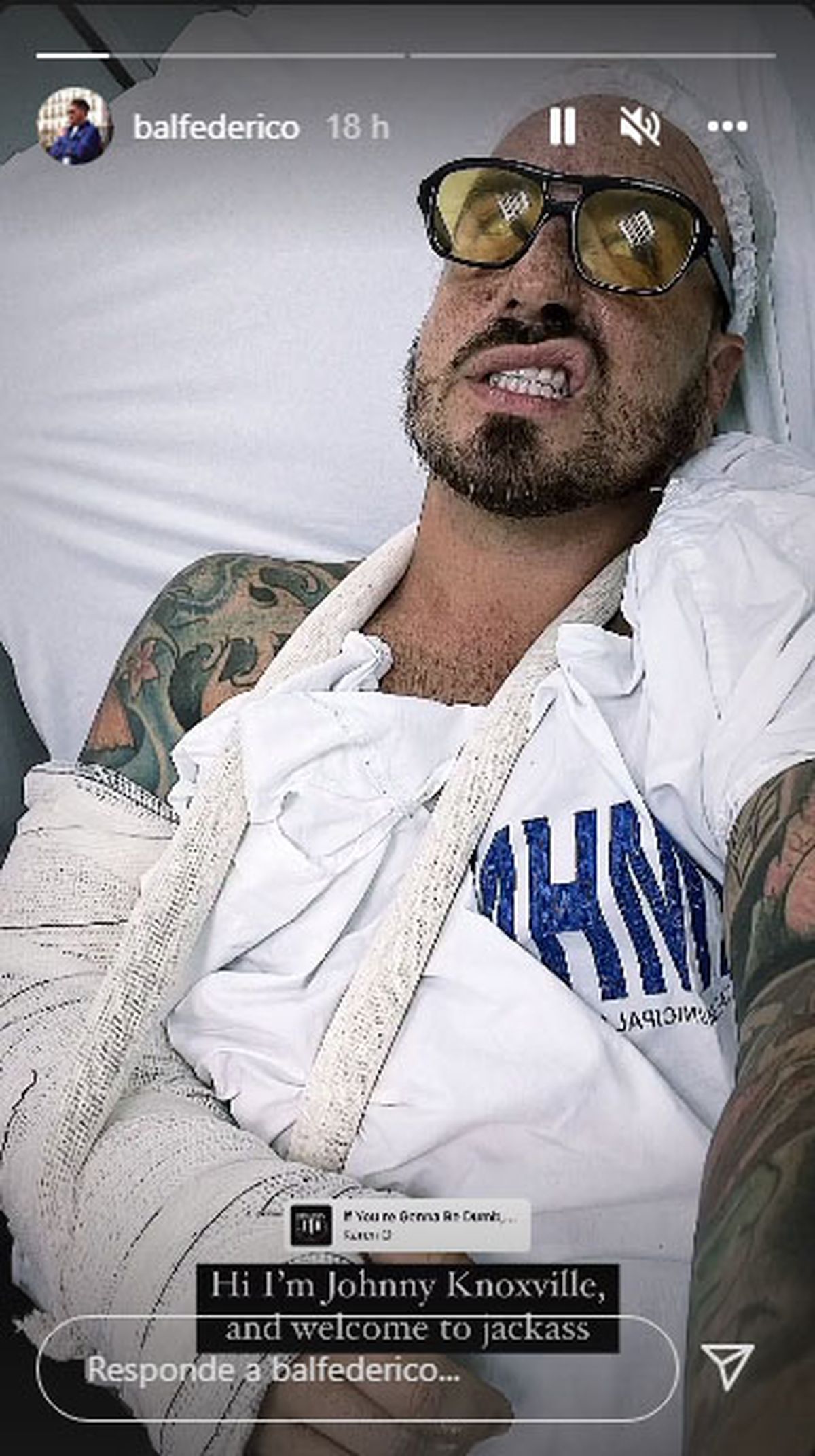 Una de las fotos de Fede Bal en sus redes, después del accidente. Se comparó con Johnny Noxville.