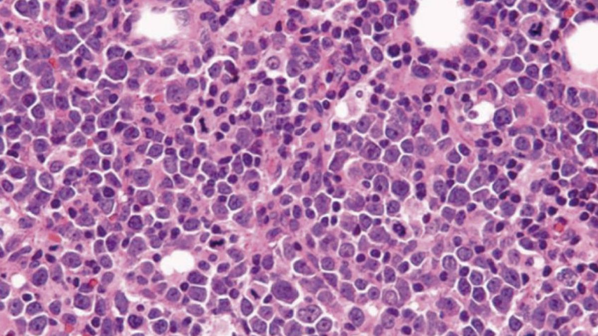 Linfoma de células del manto: alertan sobre un cáncer hematológico poco frecuente