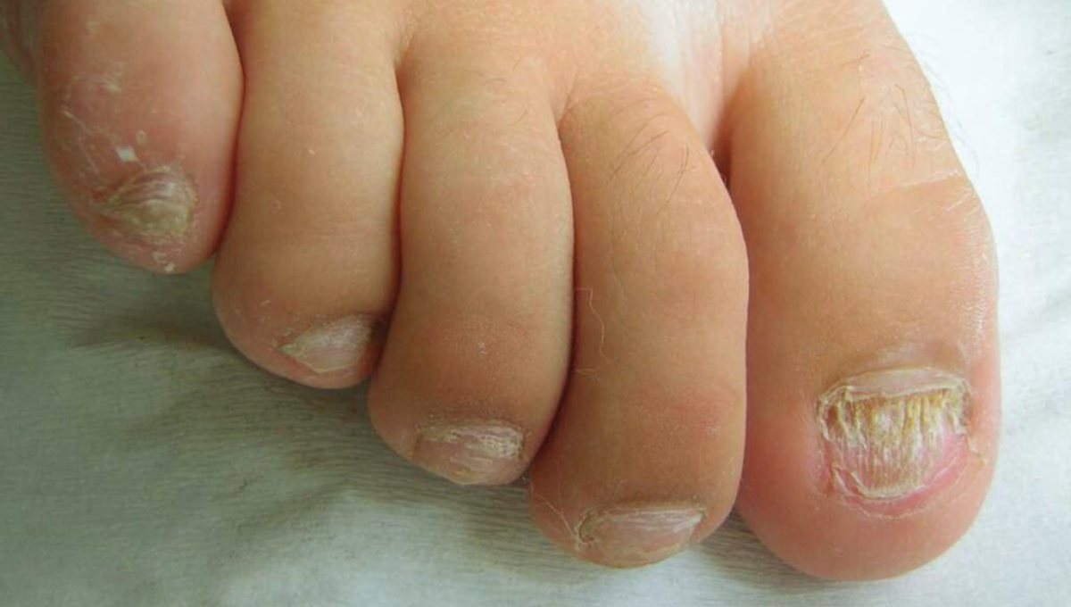 La onicomicosis es la alteración producida por la invasión de hongos en la estructura ungueal de manos y pies