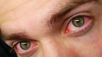 La conjuntivitis, ¿síntoma de coronavirus?