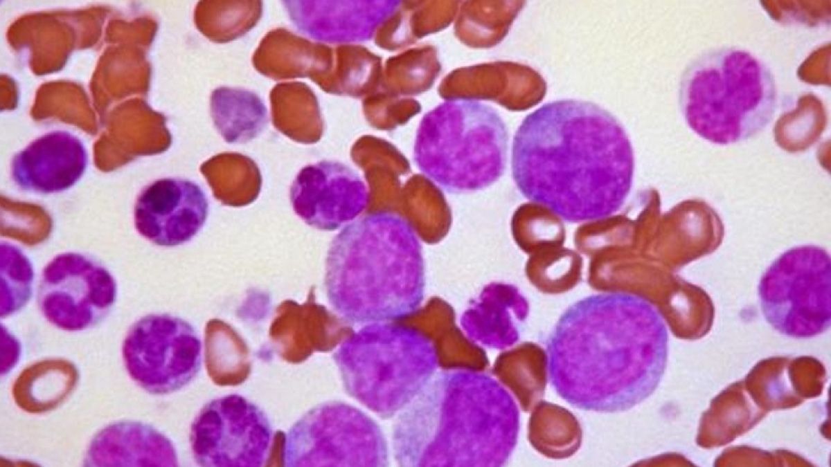 Leucemia mieloide aguda: en Argentina se diagnostican cerca de 1.200 nuevos casos por año