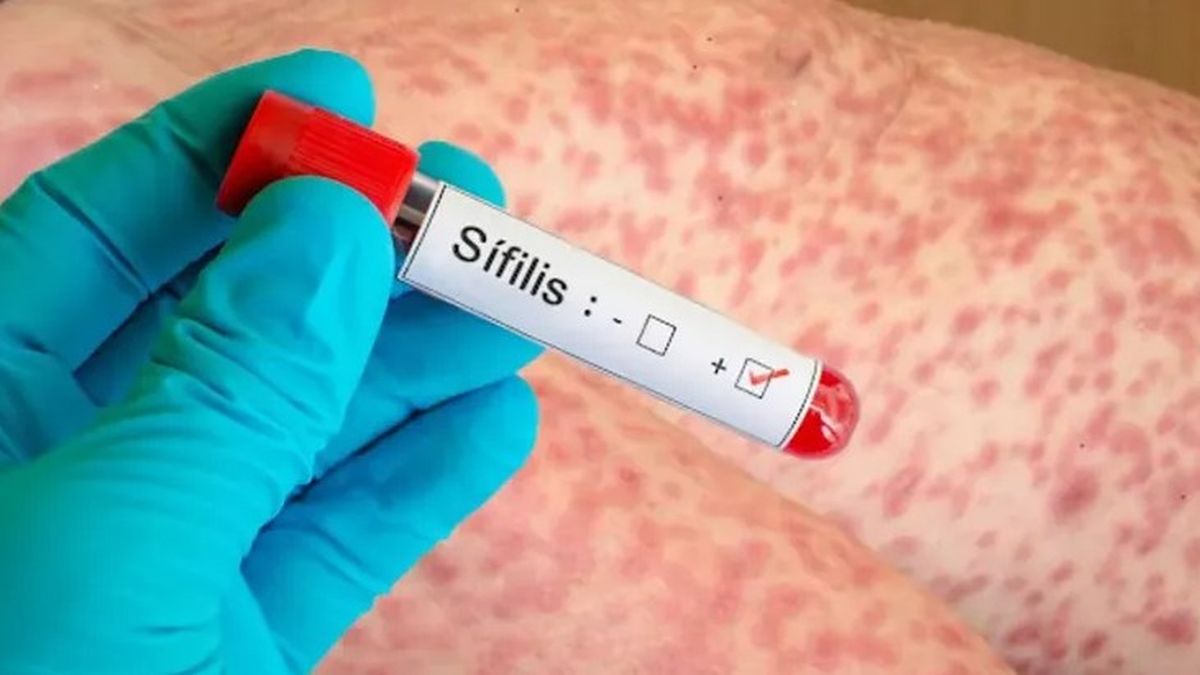 Argentina avanza en la lucha contra la sífilis y el VIH con nuevos hallazgos científicos.