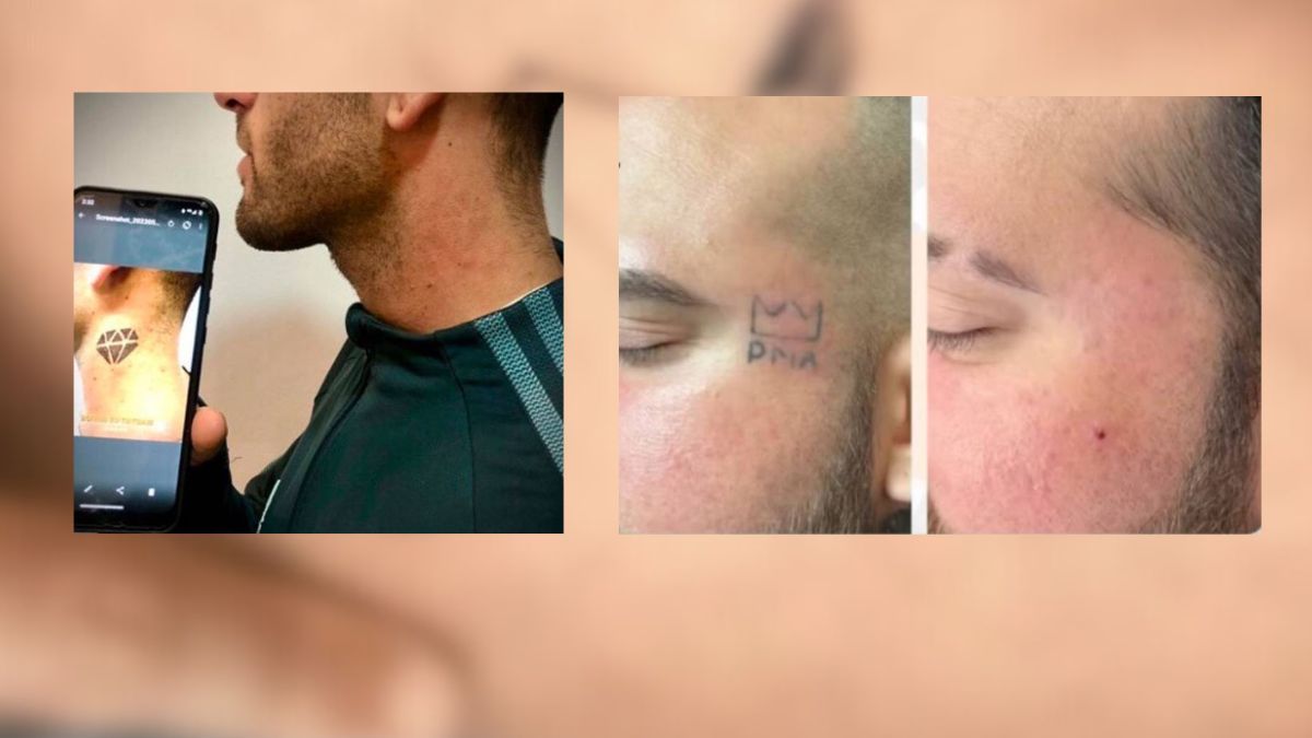 Resultados del uso de tecnología láser para borrar tatuajes por los especialistas consultados.