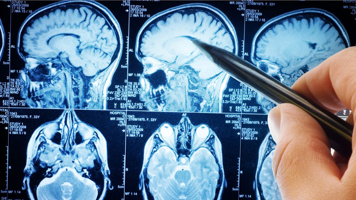 Tumores cerebrales: en Argentina se detectan cinco casos cada día Tumores cerebrales: en Argentina se detectan cinco casos cada día