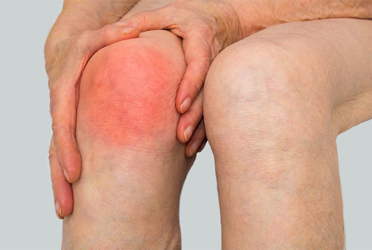 La artrosis de rodilla es uno de los problemas m&aacute;s comunes en adultos mayores.&nbsp;