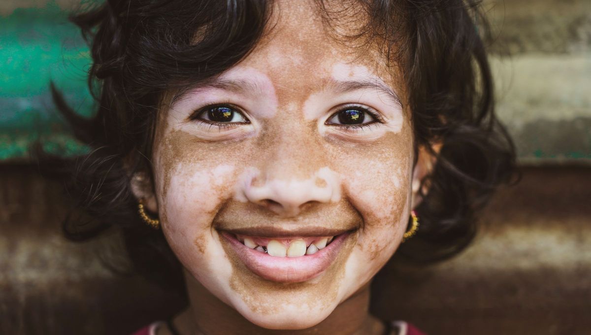 Día Mundial del Vitíligo Día Mundial del Vitíligo