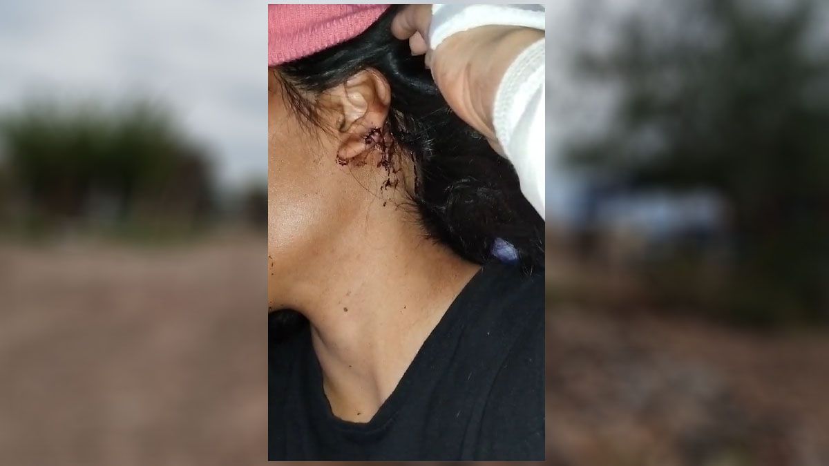El ataque de perros en Maipú le dejó a Carina heridas en su cuello, los brazos y las piernas. El ataque de perros en Maipú le dejó a Carina heridas en su cuello, los brazos y las piernas.