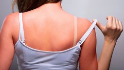 Cuida tu piel de las quemaduras solares durante el verano y todo el año.&nbsp;