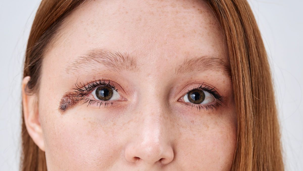 Se cree que las manchas de nacimiento son pruebas de nuestras vidas pasadas, ofreciendo pistas en algunos casos sobre cómo morimos en ellas. Se cree que las manchas de nacimiento son pruebas de nuestras vidas pasadas, ofreciendo pistas en algunos casos sobre cómo morimos en ellas.