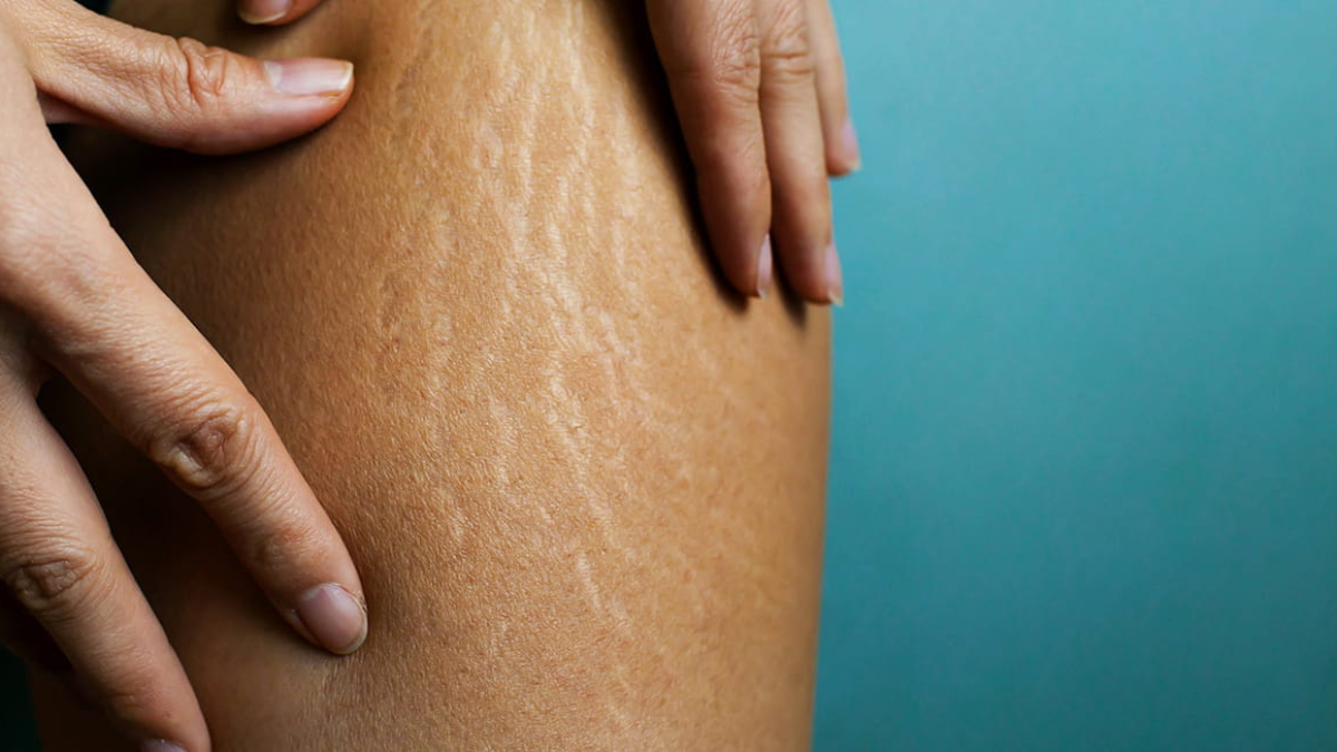 Con este increíble aceite de Mercadona trata en profundidad las estrías.