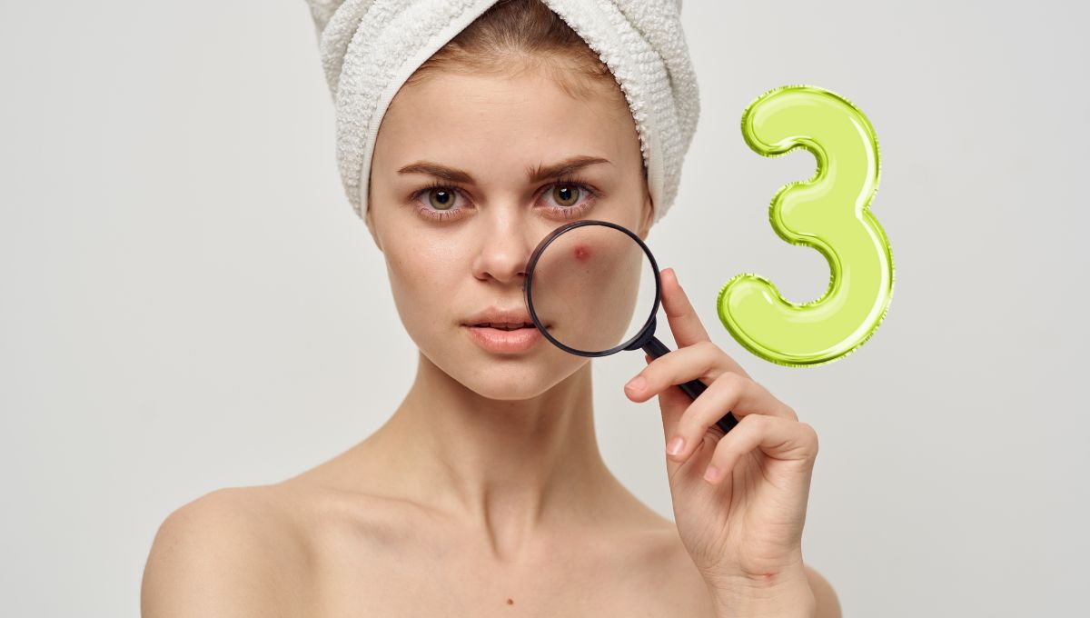 3 causas del acné que no tienen que ver con cambios hormonales