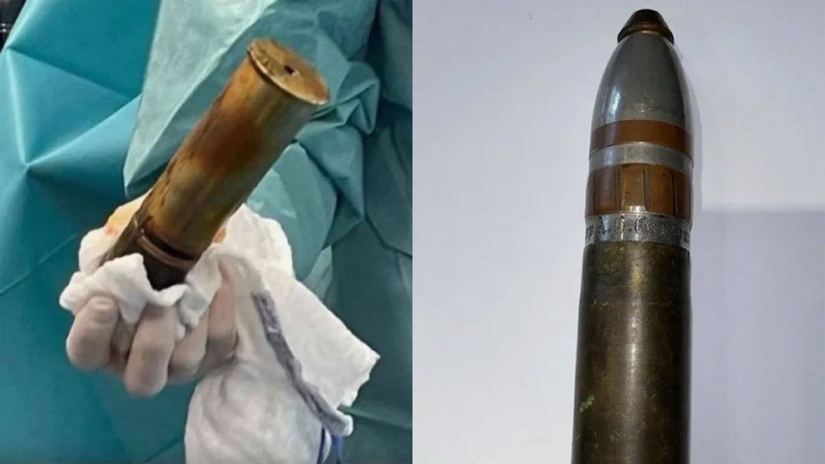 Un hombre entró al hospital con un proyectil de la Primera Guerra Mundial alojado en el recto