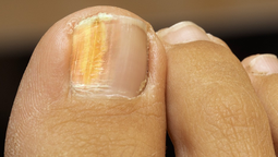 Como utilizar el vinagre de manzana para quitar los hongos de las uñas