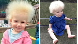 El video de una influencer que comparte su experiencia de su bebe con el síndrome del pelo indomable
