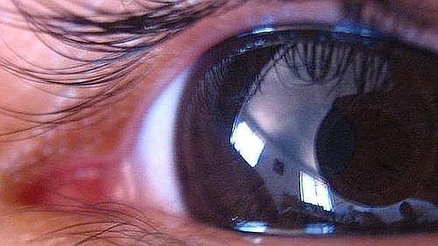 Más de dos millones de argentinos padecen glaucoma