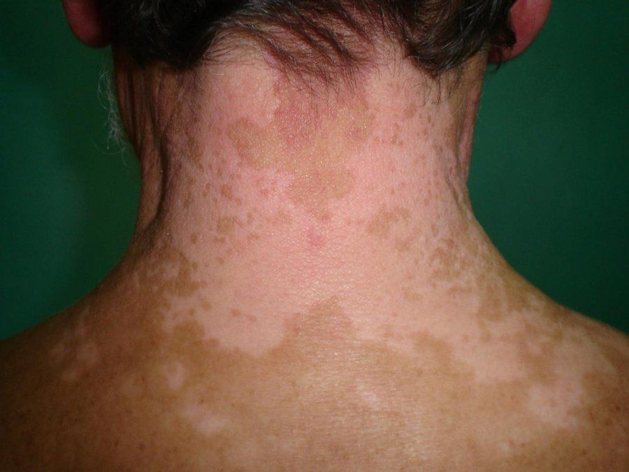 Advierten que quemaduras solares pueden causar vitiligo