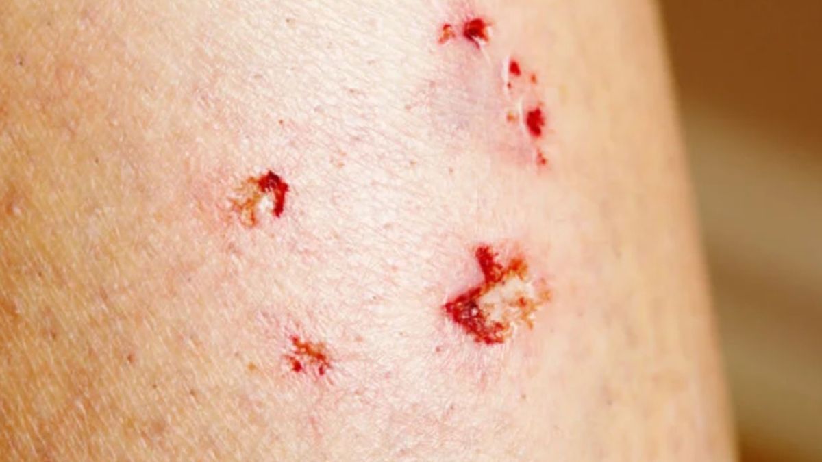 La mordedura de perros puede resultar grave si ha sido contagiado de rabia por otro animal. La mordedura de perros puede resultar grave si ha sido contagiado de rabia por otro animal.