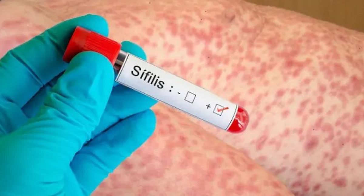 Los casos de sífilis crecieron 38% en un año en Mendoza