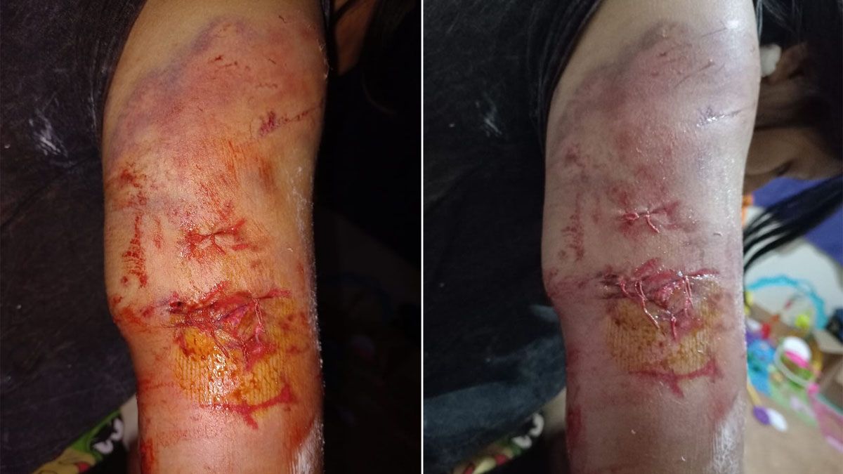 Las heridas que sufrió la mamá, que intentó proteger a su hijita poniéndose adelante. Las heridas que sufrió la mamá, que intentó proteger a su hijita poniéndose adelante.
