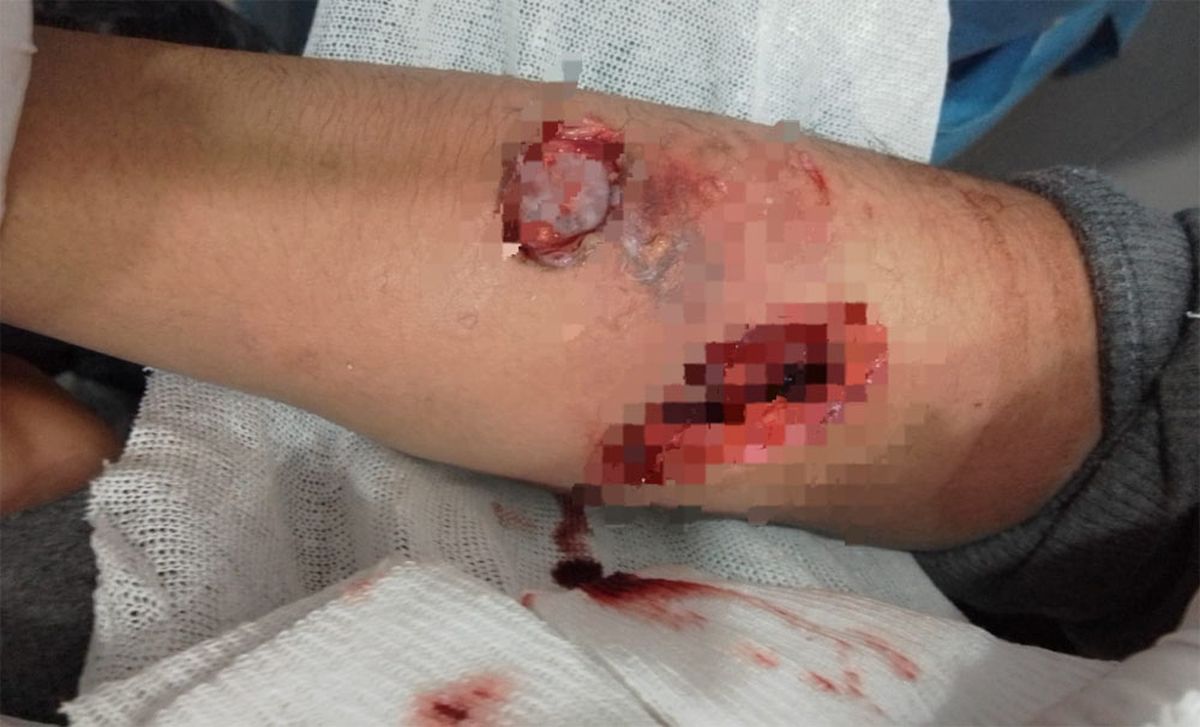 Así quedó el brazo del joven de 17 años que fue atacado por un pitbull en Guaymallén.