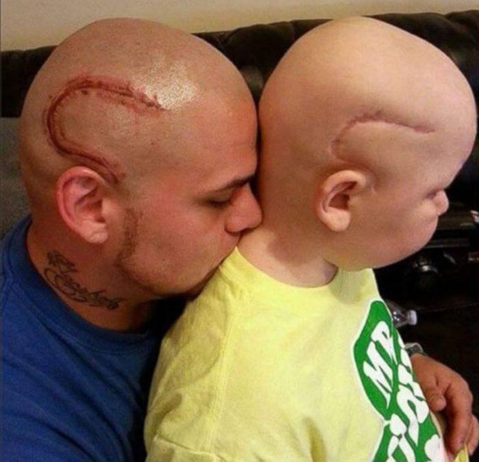 Amor total: se tatuó la cicatriz de su hijo, operado de cáncer