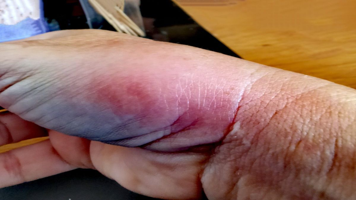 Araña violinista: cómo identificar una picadura y qué remedios aplicar en este caso Araña violinista: cómo identificar una picadura y qué remedios aplicar en este caso