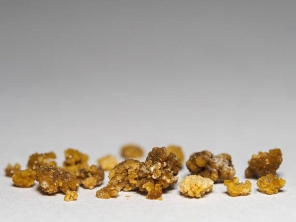 Tomaba 3 litros de Coca-Cola por día y le sacaron 35 piedras de la vejiga Tomaba 3 litros de Coca-Cola por día y le sacaron 35 piedras de la vejiga