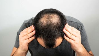 Descubrimiento de una posible cura para la calvicie en apenas 20 días sorprende a los especialistas Descubrimiento de una posible cura para la calvicie en apenas 20 días sorprende a los especialistas