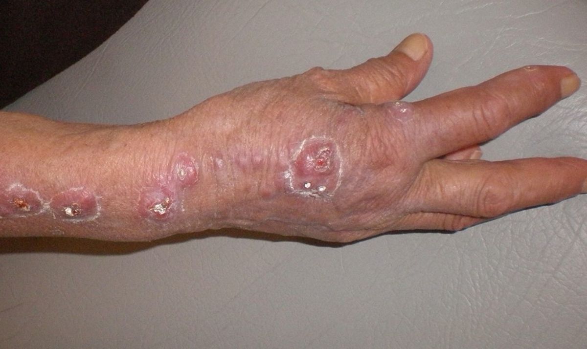 Este hongo puede causar úlceras difíciles de tratar. Este hongo puede causar úlceras difíciles de tratar. 