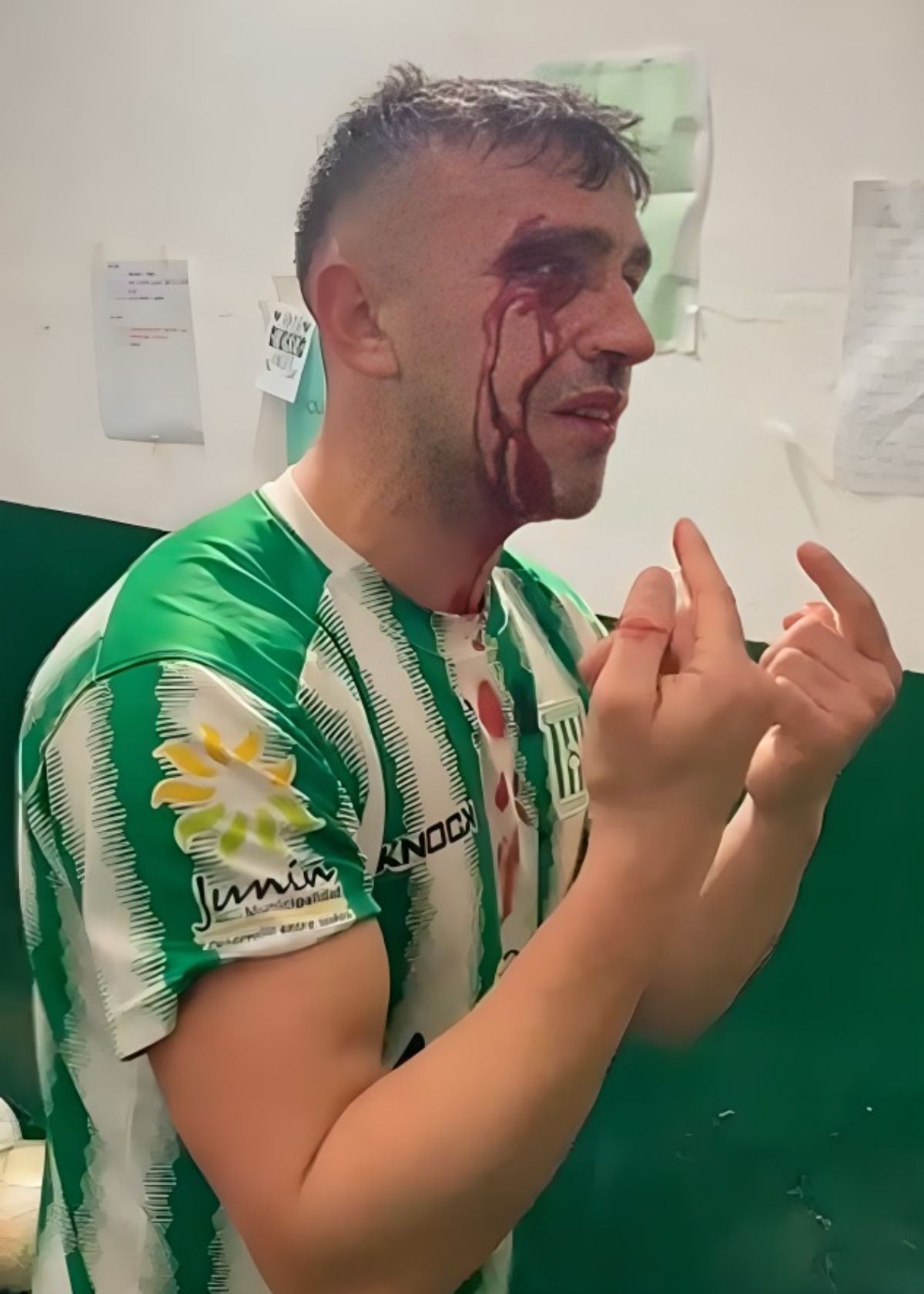 Octavio Pacini fue uno de los heridos en los incidentes registrados en la Liga Rivadaviense. Octavio Pacini fue uno de los heridos en los incidentes registrados en la Liga Rivadaviense.