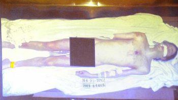 Revelaron que Michael Jackson sufría de vitíligo, artritis y era casi ciego